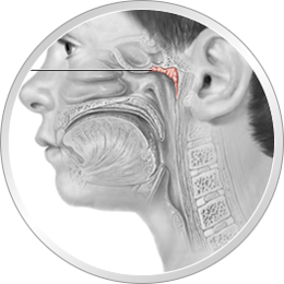 adenoid